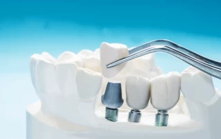 зубные имплантаты